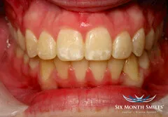 Six Month Smiles - After