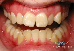 Six Month Smiles - Before