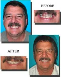Tallahassee Full Mouth Dental Rehabilitation
