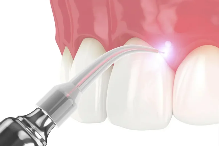 Soft tissue laser at Apalachee Bay Family Dental in Tallahassee, FL.
